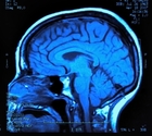 braininjury-thumb-140x125-17944.jpg
