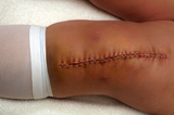 kneesurgery-thumb-160x106-30869.jpg
